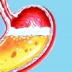 Гастрит с повышенной кислотностью: симптомы, лечение, причины, питание Картинка - Гастрит с повышенной кислотностью: симптомы, лечение, причины, питание