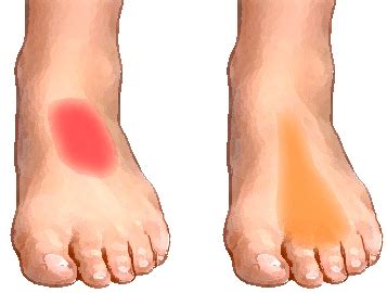 Ankle Pain On Top Of Foot Hot Sex Picture