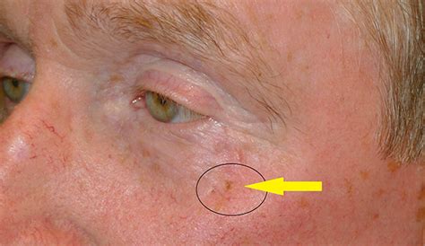 These skin cancer pictures will help you differentiate the different types, including basal cell and squamous cell carcinomas, melanoma, actinic keratosis, and merkel cell carcinoma. Skin Cancer Treatment Chicago IL | Skokie | Northbrook ...