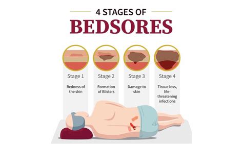 The 4 Different Stages Of Bedsores