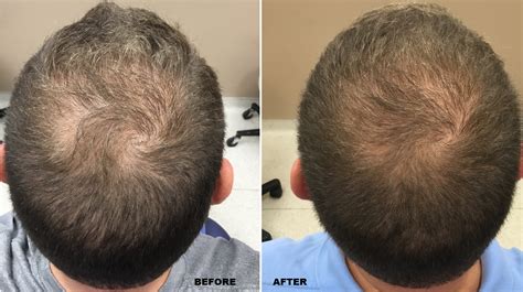 4 months after adipose stem cells and. Check out our latest before and after for PRP Hair ...