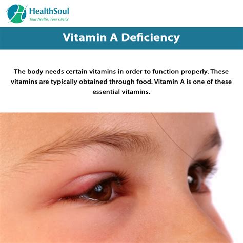 Vitamin A Deficiency Healthsoul