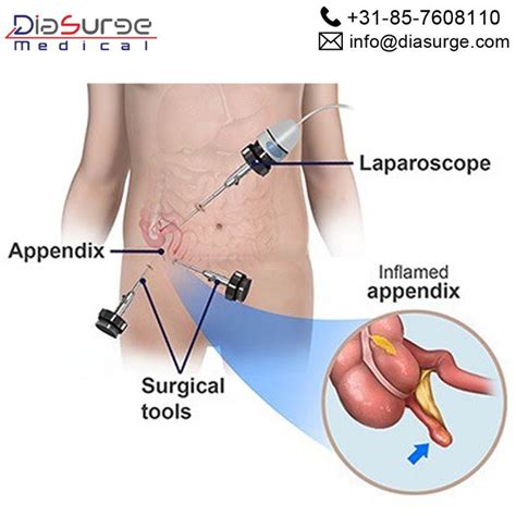 Appendectomy Laparoscopic Surgery Medical Laparoscopic Surgery