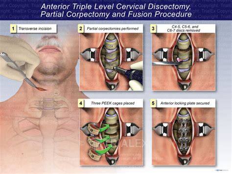 Anterior Triple Level Cervical Discectomy Partial Corpectomy And