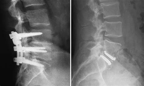 Artificial Disk Replacement In The Lumbar Spine Orthoinfo Aaos