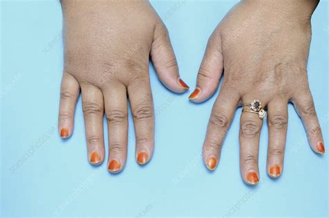 Lymphoedema Of The Hand Stock Image C0095302 Science Photo Library
