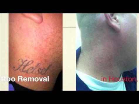 Maybe you would like to learn more about one of these? How Much Does Laser Tattoo Removal Cost - YouTube