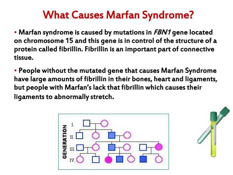 Marfan Syndrome Chromosome 15 Captions Hunter