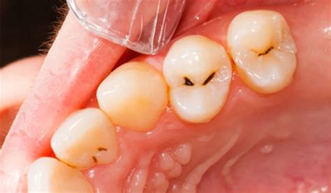 Infección De Boca En Getxo Clínica Dental Letamendia