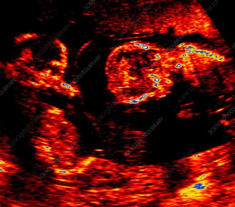 Ultrasound Scan Of Twins Stock Image P6800354 Science Photo Library