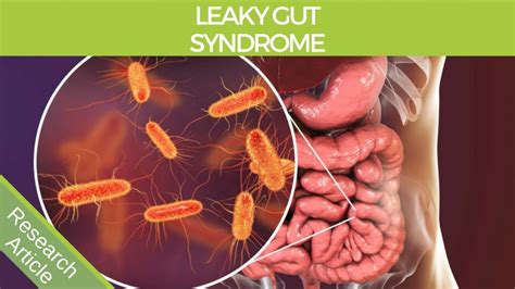 Leaky Gut Syndrome Causes And Natural Solutions Brett Elliott