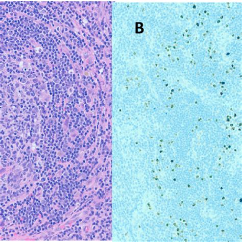 Axillary Lymph Node Biopsy Medium Power Photomicrographs Showing A