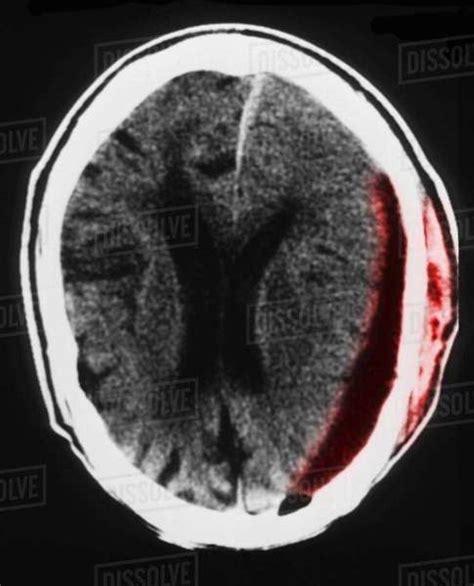 CT Scan Of Brain Showing Subdural Hematoma Stock Photo Dissolve