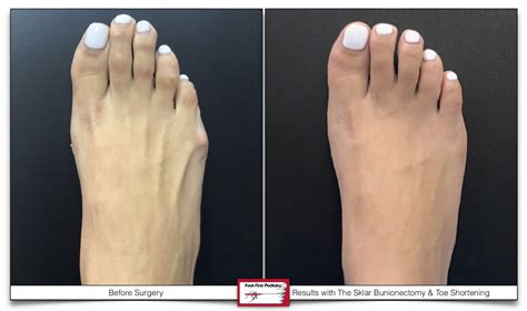 Toe Shortening Andor Straightening — Foot First Podiatry Centers