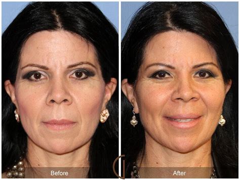 Facial Fat Grafting Before And After Photos Patient 31 Dr Kevin Sadati