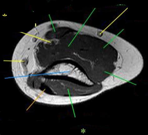 Elbow Axial Mri 1 Diagram Quizlet