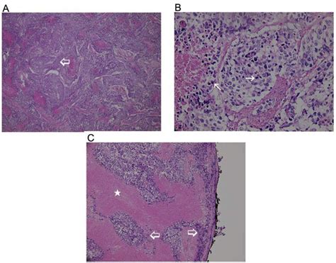 Histology Of The Uterine Specimen From Debulking Surgery The Tumor