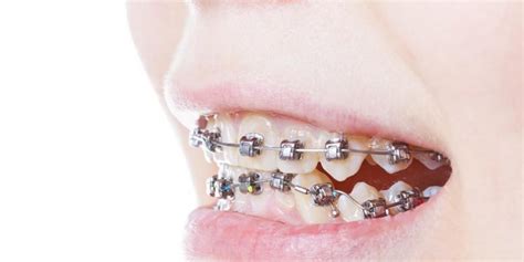 Peut On Faire De La Boxe Avec Un Appareil Dentaire - Appareil dentaire : que faire quand les gencives sont gonflées