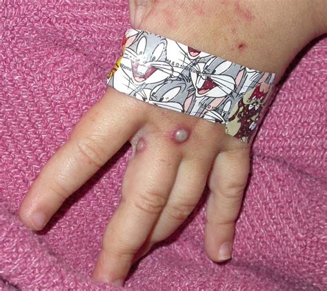 Monkeypox is a rare, potentially serious viral illness that usually starts with monkeypox is in the same family of viruses as smallpox, but results in a milder illness, the cdc said. Monkeypox - The Clinical Advisor