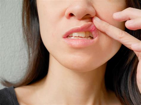 What Are The Different Types Of Canker Sores