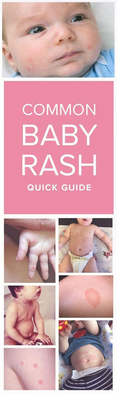 Baby Rash Visual Guide Images