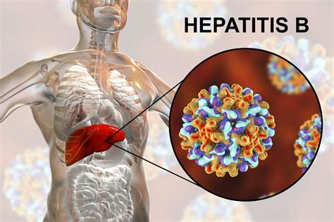 But in children, it often persists for years and may eventually cause serious liver damage. Hepatitis-B: Warum das Immunsystem das Virus nicht ...