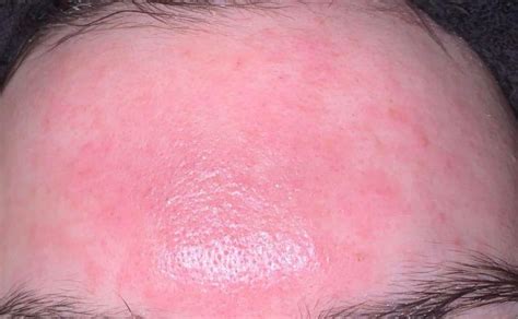 Burning And Redness On Forehead Rdermatologyquestions