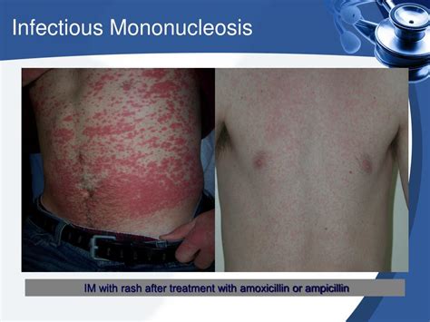 Ppt Infectious Mononucleosis Powerpoint Presentation Free Download