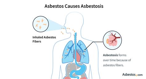 Treatment Options For Asbestosis The Mesothelioma Center