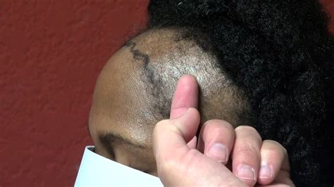 Black Women Receding Hairline Bald Hair Loss Temple Corners Bay Area Ca