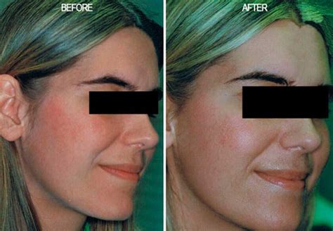 Fotofacial Treatment Nyc Fotofacial New York