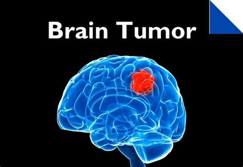 Most brain tumors in infants and children require surgical removal, or at least a biopsy, as part of the treatment. Meningioma | Department of Neurology and Neurosurgery