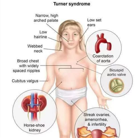 Syndrome Definition And Examples Biology Online Dictionary