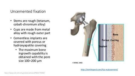 Cemented Versus Uncemented Fixation In Total Hip Replacement