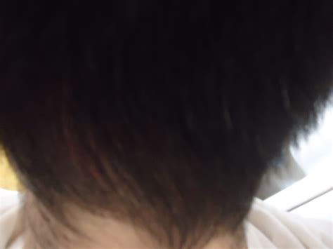 ヘアスタイルカタログ: 最高 50+ 頭皮 白 ニキビ