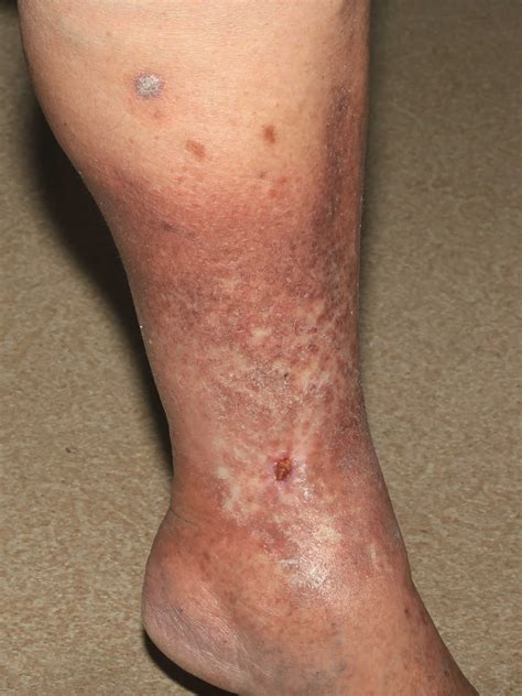 Venous Ulcer Or Venous Stasis Ulcer Causes Symptoms Diagnosis And Treatment
