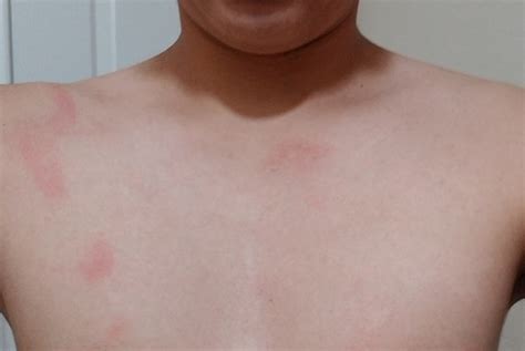 Causes Of Red Rash On Chest My XXX Hot Girl