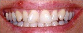 If using veneers to make your teeth appear straight isn't an option in your case, here are two alternative options for straightening your teeth. Fix Crooked Teeth | Cosmetic Dentistry