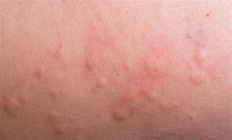 What Are The Treatments For An Allergic Reaction To Msg