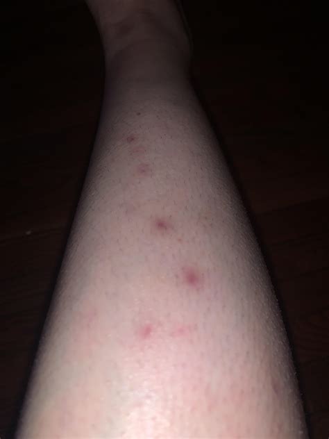 Hey Guys Recovering From Crazy Follicular Eczema Flare On Lower Legs Left Over “scarring