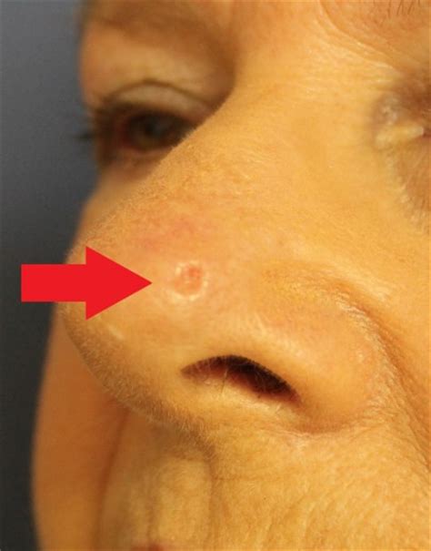 Why is red nose and how is it treated? Skin cancer nose and local flap repair before and after