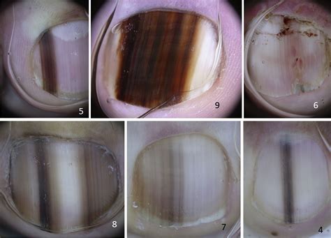 Association Of Subungual Melanoma And Subungual Squamous Cell Carcinoma