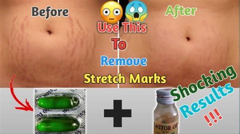 How To Remove Stretch Marks 3 Easy Steps Stretch Marks हटाने के 3