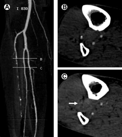 Ct Angiography Of Peripheral Arterial Occlusive Disease Techniques In