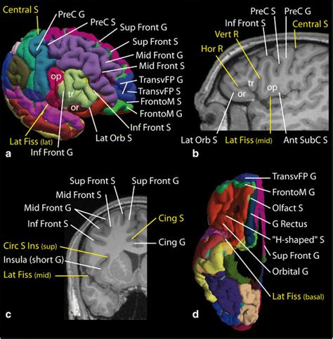 Identification Of The Sulci And Gyri Of The Frontal Lobe Lateral And Download Scientific