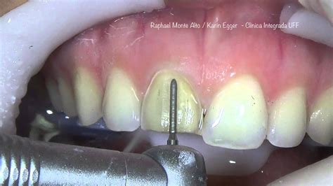 Preparo E Provisória Para Facetas Unitárias Dentes Com Resina Implantes Dentários Dentário