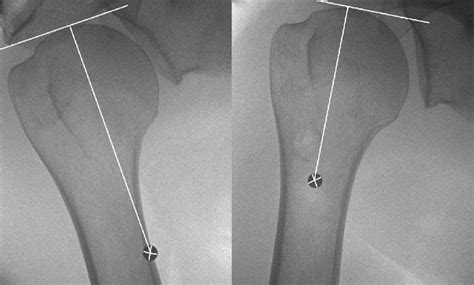 Anteroposterior Preoperative Left And Postoperative Right