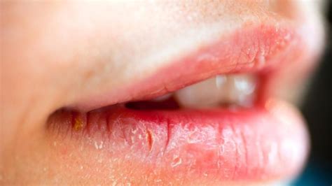 How To Heal Cracked Lip Corners Fast Its Charming Time
