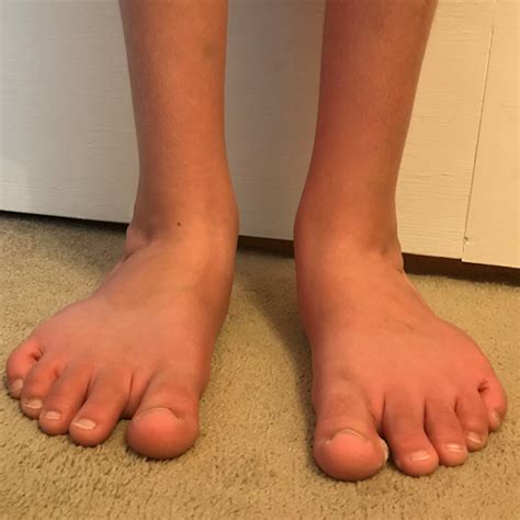 FLAT FEET in Children – Care For Feet