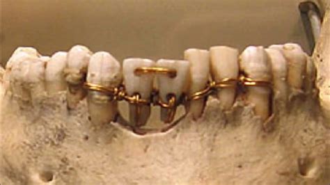 Prótesis Dental En La Historia La Primera Fue Antes De Cristo Youtube